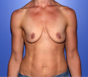 Patient before breast augmentation in NYC