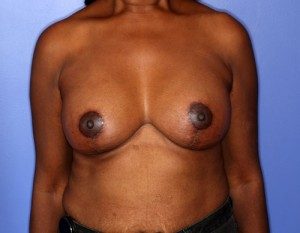 Patient results after a breast lift