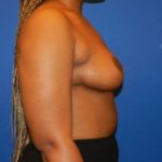 Results of a breast lift with Dr. Cangello