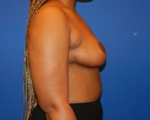 Breast Reduction patient after