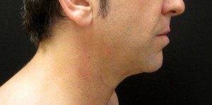 Chin Implant patient before