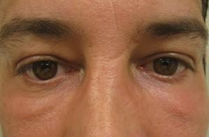 Results of NYC lower eyelid lift