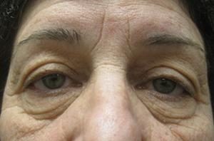 Female patient before an NYC eyelid lift