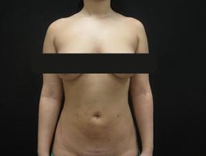 Results of NYC lipo with Dr. Cangello