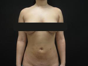 Liposuction patient after