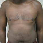 Results of male breast reduction in NYC
