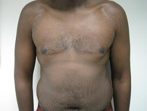 Results of male breast reduction in NYC