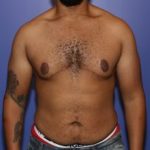 After a male breast reduction in NYC