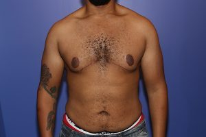 After a male breast reduction in NYC