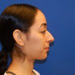 Before rhinoplasty in NYC with Dr. Cangello
