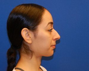 Before rhinoplasty in NYC with Dr. Cangello