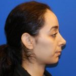 Results of an NYC nose job from Dr. Cangello