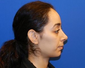 Results of an NYC nose job from Dr. Cangello
