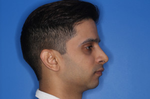 Result of rhinoplasty with Dr. Cangello