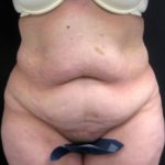 Patient before a tummy tuck with Dr. Cangello