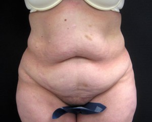 Tummy Tuck patient before