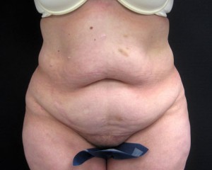 Tummy Tuck Manhattan, Abdominoplasty NYC