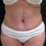 Results of NYC abdominoplasty with Dr. Cangello