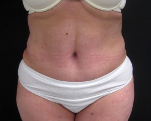 Tummy Tuck patient after