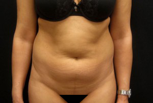 Before stomach liposuction in NYC