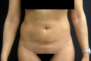 Results of abdominal lipo in NYC with Dr. Cangello
