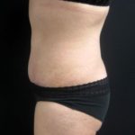Profile view of NYC tummy tuck results