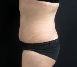Tummy Tuck patient after