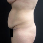 Side view of patient before a tummy tuck