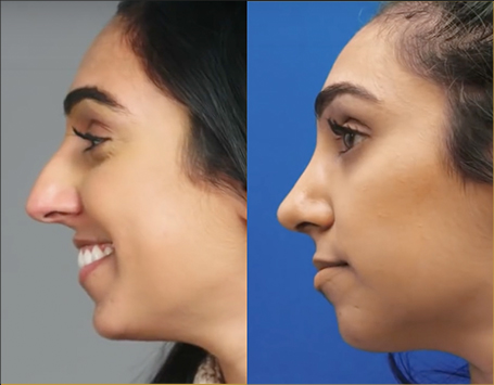 how much is a non surgical nose job toronto