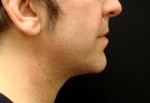 Results of chin augmentation from Dr. Cangello