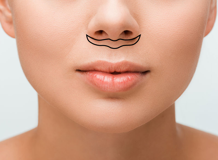 Upper lip lift diagram