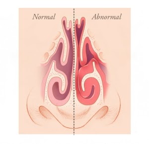 Turbinates: normal and abnormal comparison