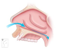 Airflow after turbinate reduction