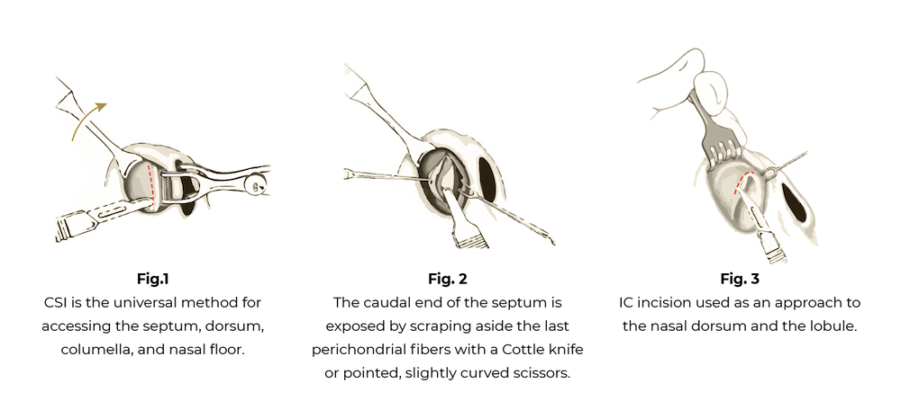 septoplasty diagram