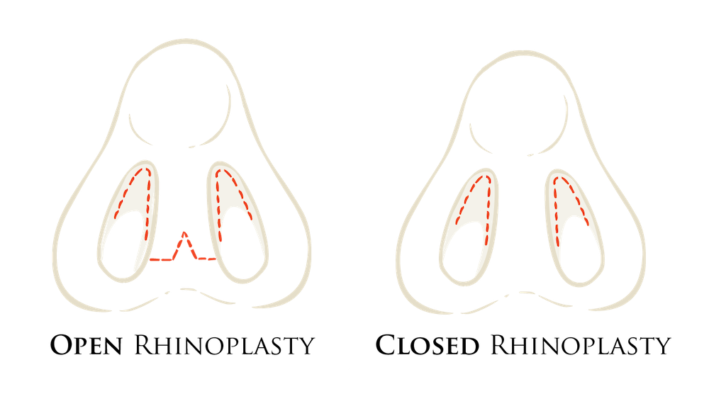 open vs closed rhinoplasty diagram