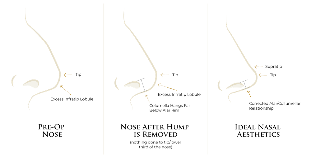 scarless rhinoplasty illustration