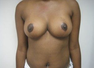 Results of NYC breast reduction surgery