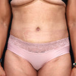 Dr. Cangello Tummy Tuck Procedure After Picture 1