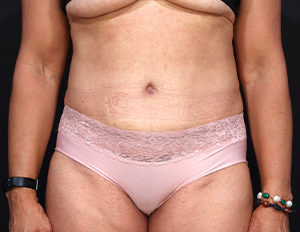 Dr. Cangello Tummy Tuck Procedure After Picture 1