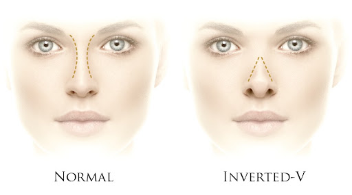 Inverted V nasal deformity