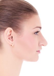 Figure 10. Excess columellar show with retracted nostrils, lateral view.
