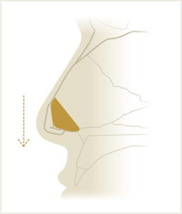 Figure 5. Caudal septum deviation (gold), lateral view.