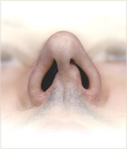 Figure 6. Caudal septum deviation, proximal view. Actual patient of Dr. Cangello’s.