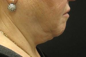 Patient in side before before a neck lift
