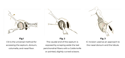 Graphic depicting rhinoplasty