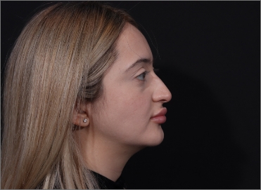 Scarless Rhinoplasty NYC Top Closed Nose Job Surgeon New York City