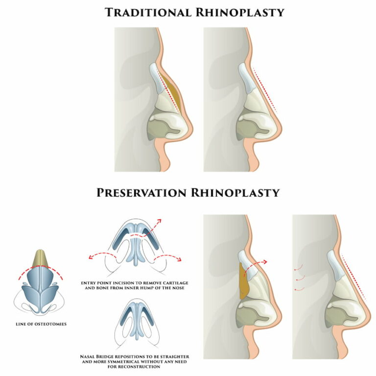 Osteotomies Tutorial | Narrowing a Wide Nasal Bridge NYC