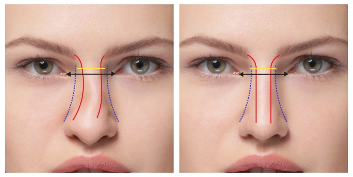 Graphic depicting crooked dorsal aesthetic lines vs. straight dorsal aesthetic lines