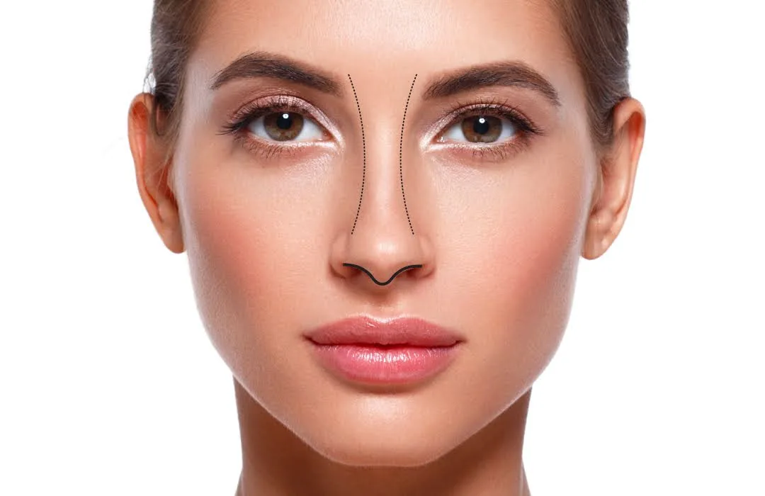 Preservation Rhinoplasty graphic