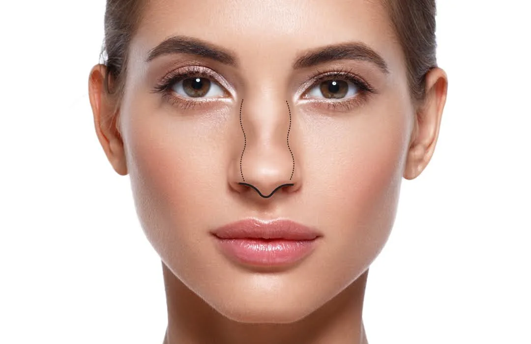 Structural Rhinoplasty graphic